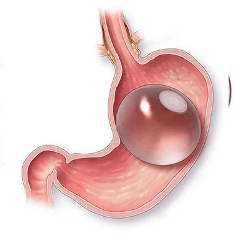 Gastric Balloon Abu Dhabi & UAE